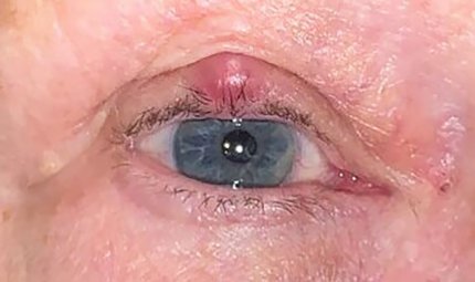 Arpacık Ve Şalazyon